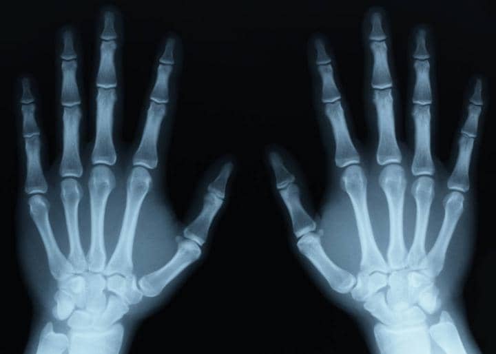 Broken Bones and Fracture